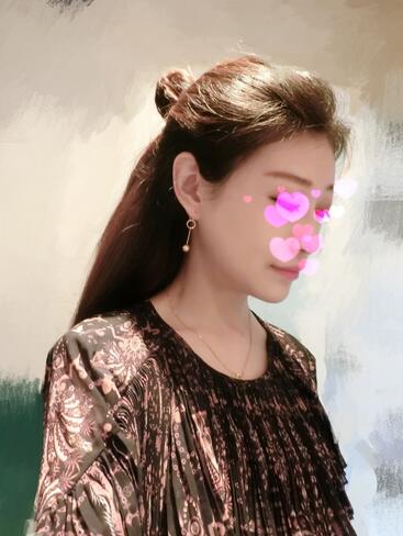 北京葉子磨下頜角整形的果圖