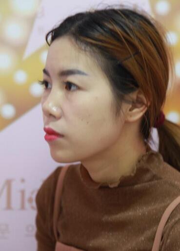 隆鼻整形一個月恢復期圖片 武漢壹加壹隆鼻整形案例