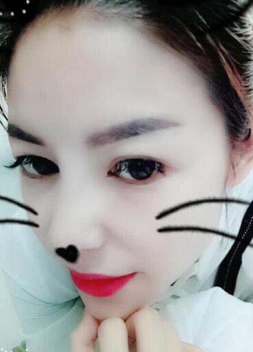 隆鼻整形一個月恢復期圖片 武漢壹加壹隆鼻整形案例