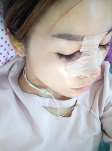 隆鼻整形一個月恢復期圖片 武漢壹加壹隆鼻整形案例