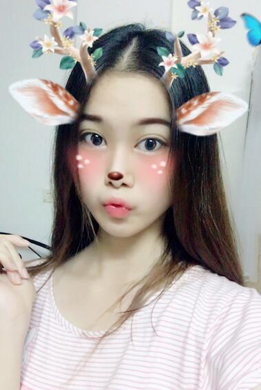 韓式微創(chuàng)雙眼皮恢復(fù)圖 深圳妍熙雙眼皮半年