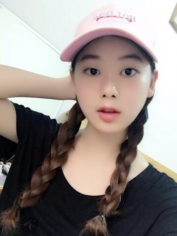 韓式微創(chuàng)雙眼皮恢復(fù)圖 深圳妍熙雙眼皮半年