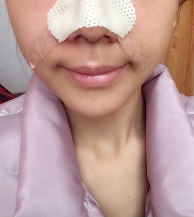 北京藝星王英勇隆鼻案例 隆鼻整形三個(gè)月