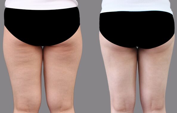 大腿吸脂減肥術(shù)后多久恢復(fù),幾天能消腫