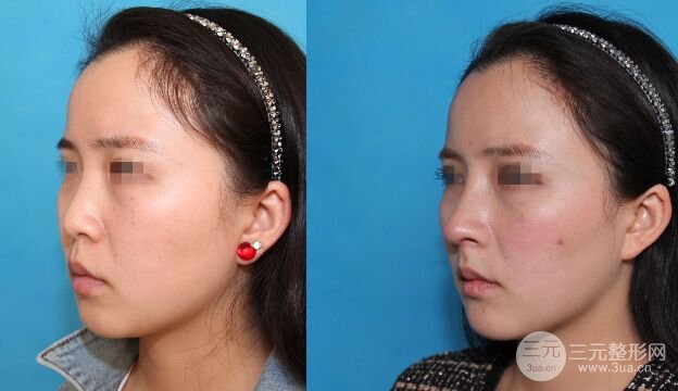 鼻整形手術(shù)幾天可以恢復(fù)，多久消腫