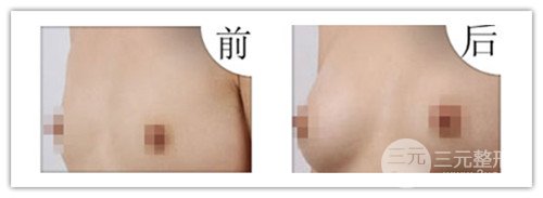 假體隆胸后可以運動嗎，可以鍛煉嗎