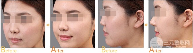 自體軟骨隆鼻會(huì)出現(xiàn)排異嗎，可靠性如何