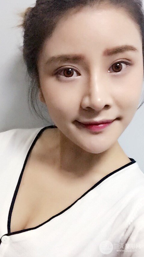 淄博陽(yáng)光整形自體脂肪隆胸前后對(duì)比圖,真實(shí)案例