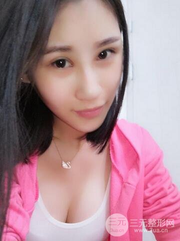 曼托假體+自體脂肪豐胸前后對(duì)比 重慶軍美打造果凍胸