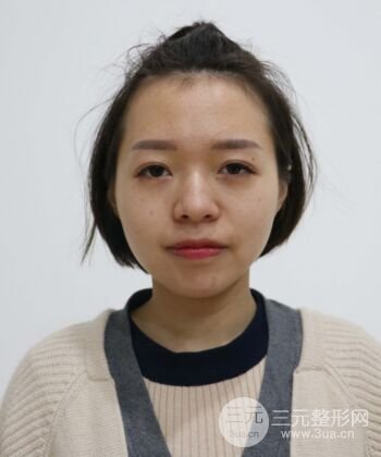 硅膠假體隆鼻+耳軟骨墊鼻尖四個(gè)月恢復(fù)果圖