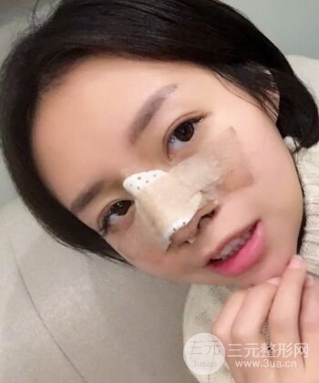 硅膠假體隆鼻+耳軟骨墊鼻尖四個(gè)月恢復(fù)果圖