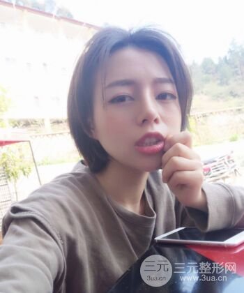 硅膠假體隆鼻+耳軟骨墊鼻尖四個(gè)月恢復(fù)果圖