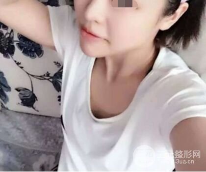 自體脂肪隆胸果超出預(yù)期,擁有**身材不是夢(mèng)