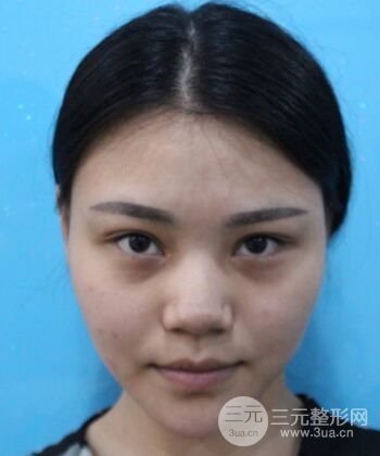 在漢中韓美做了隆鼻整形一個(gè)月，恢復(fù)越來(lái)越自然了