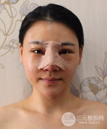 在漢中韓美做了隆鼻整形一個(gè)月，恢復(fù)越來(lái)越自然了