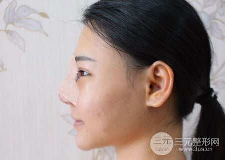 在漢中韓美做了隆鼻整形一個(gè)月，恢復(fù)越來(lái)越自然了