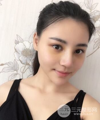 在漢中韓美做了隆鼻整形一個(gè)月，恢復(fù)越來(lái)越自然了