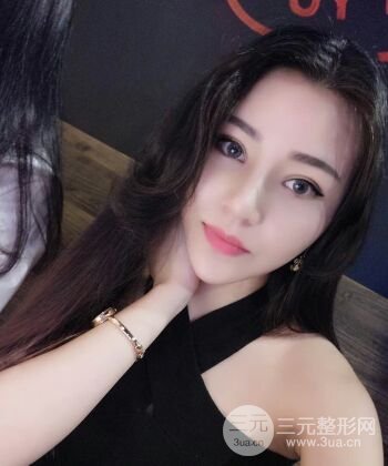 在漢中韓美做了隆鼻整形一個(gè)月，恢復(fù)越來(lái)越自然了