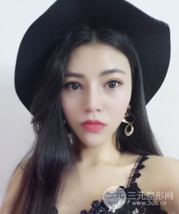 在漢中韓美做了隆鼻整形一個(gè)月，恢復(fù)越來(lái)越自然了