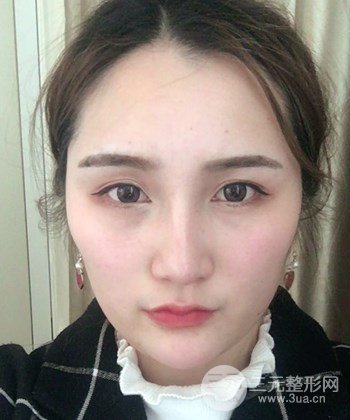 面部埋埋蛋白線.提升前后對比照片，皮膚緊致了不少