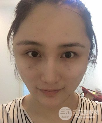 面部埋埋蛋白線.提升前后對比照片，皮膚緊致了不少