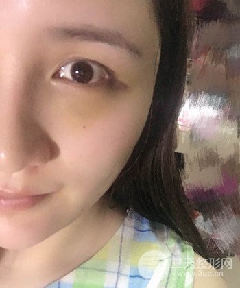 面部埋埋蛋白線.提升前后對比照片，皮膚緊致了不少