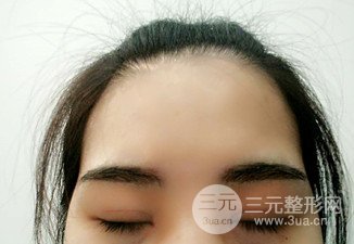 漢中韓美切開雙眼皮開眼角恢復(fù)對比照片