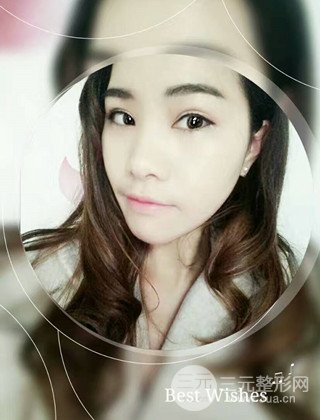 漢中韓美切開雙眼皮開眼角恢復(fù)對比照片