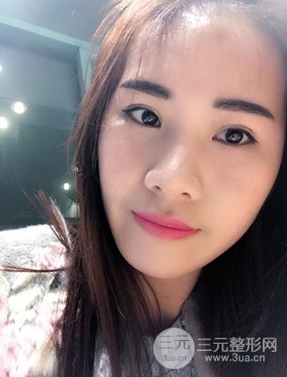 漢中韓美切開雙眼皮開眼角恢復(fù)對比照片