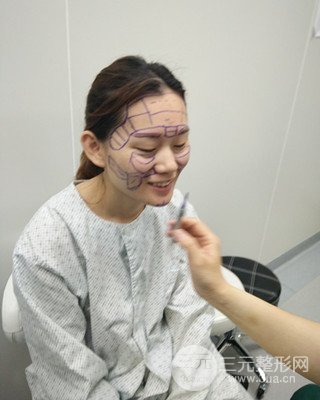 南昌永康自體脂肪面部填充兩個(gè)半月果圖