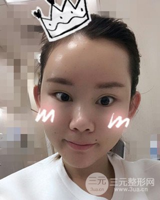 南昌永康自體脂肪面部填充兩個(gè)半月果圖