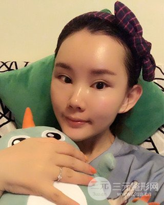 南昌永康自體脂肪面部填充兩個(gè)半月果圖