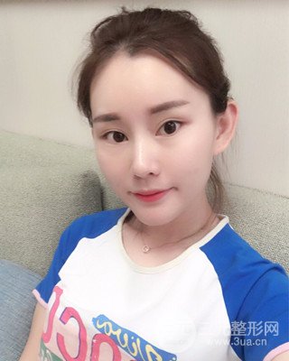 南昌永康自體脂肪面部填充兩個(gè)半月果圖