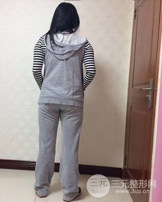 大腿吸脂前后對比照片，南昌永康王忠干真實案例分享