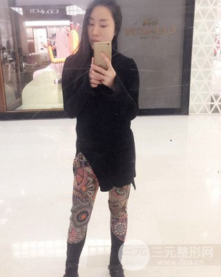 大腿吸脂前后對比照片，南昌永康王忠干真實案例分享