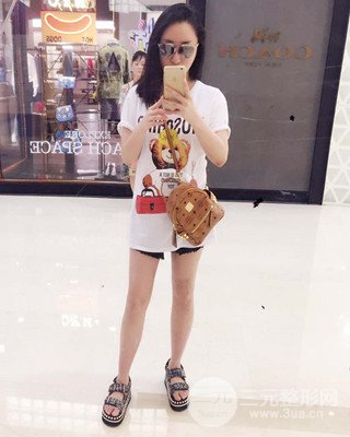 大腿吸脂前后對比照片，南昌永康王忠干真實案例分享