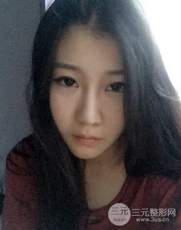 長沙鵬愛隆鼻整形果展示 恢復過程圖