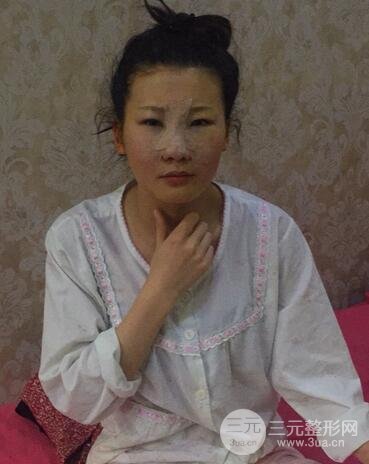 長沙鵬愛隆鼻整形果展示 恢復過程圖
