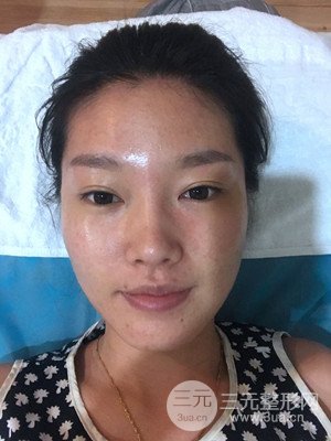 南昌永康整形打水光補(bǔ)水果圖前后對(duì)比