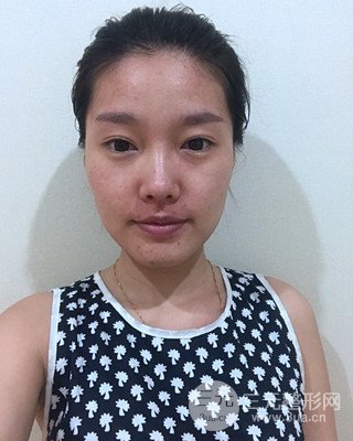 南昌永康整形打水光補(bǔ)水果圖前后對(duì)比