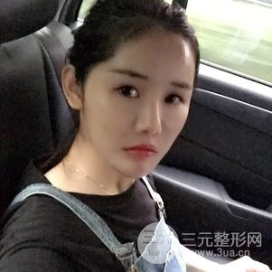 南京米尚恩陳天杰自體脂肪填充全臉 女神的養(yǎng)成記!