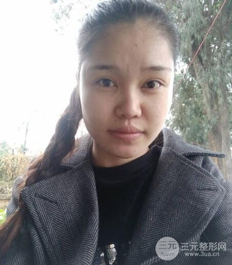 鼻頭縮小術過程圖，鼻頭縮小恢復日記