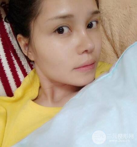 鼻頭縮小術過程圖，鼻頭縮小恢復日記