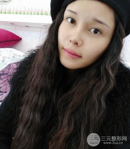 鼻頭縮小術過程圖，鼻頭縮小恢復日記