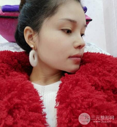 鼻頭縮小術過程圖，鼻頭縮小恢復日記