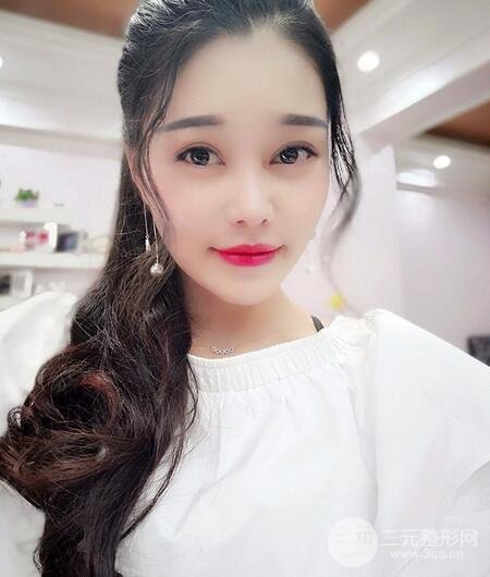 鼻頭縮小術過程圖，鼻頭縮小恢復日記