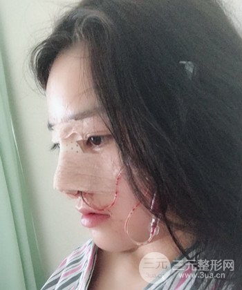 達(dá)拉斯綜合隆鼻后對(duì)比照片，顏值提高不是夢(mèng)