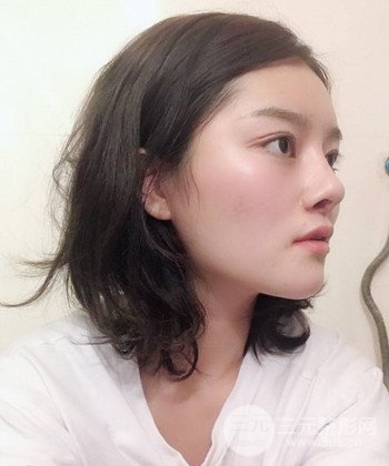 達(dá)拉斯綜合隆鼻后對(duì)比照片，顏值提高不是夢(mèng)