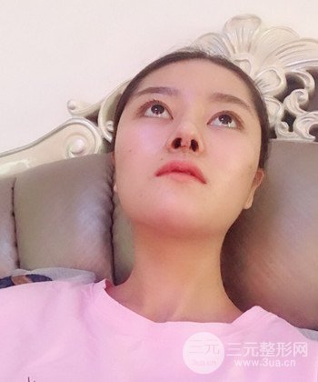 達(dá)拉斯綜合隆鼻后對(duì)比照片，顏值提高不是夢(mèng)