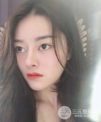 達(dá)拉斯綜合隆鼻后對(duì)比照片，顏值提高不是夢(mèng)